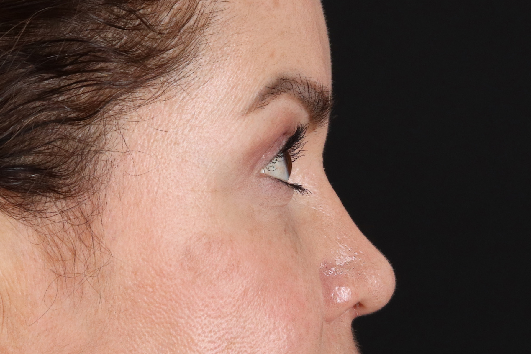 Upper Blepharoplasty Before & After Patient #12073