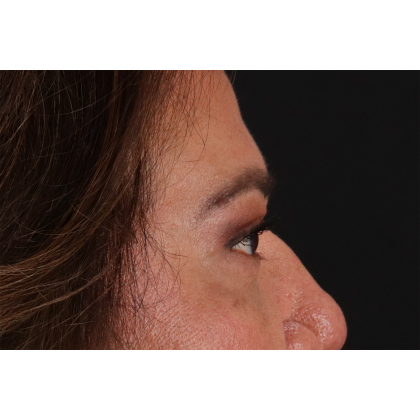 Blepharoplasty (Eyelid Surgery) Before & After Patient #11125