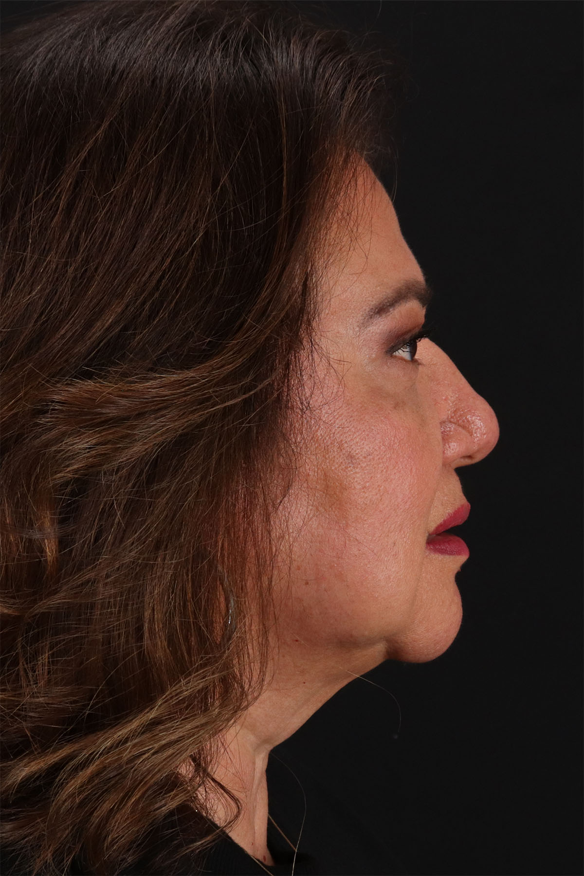 CO2 Laser Before & After Patient #11136