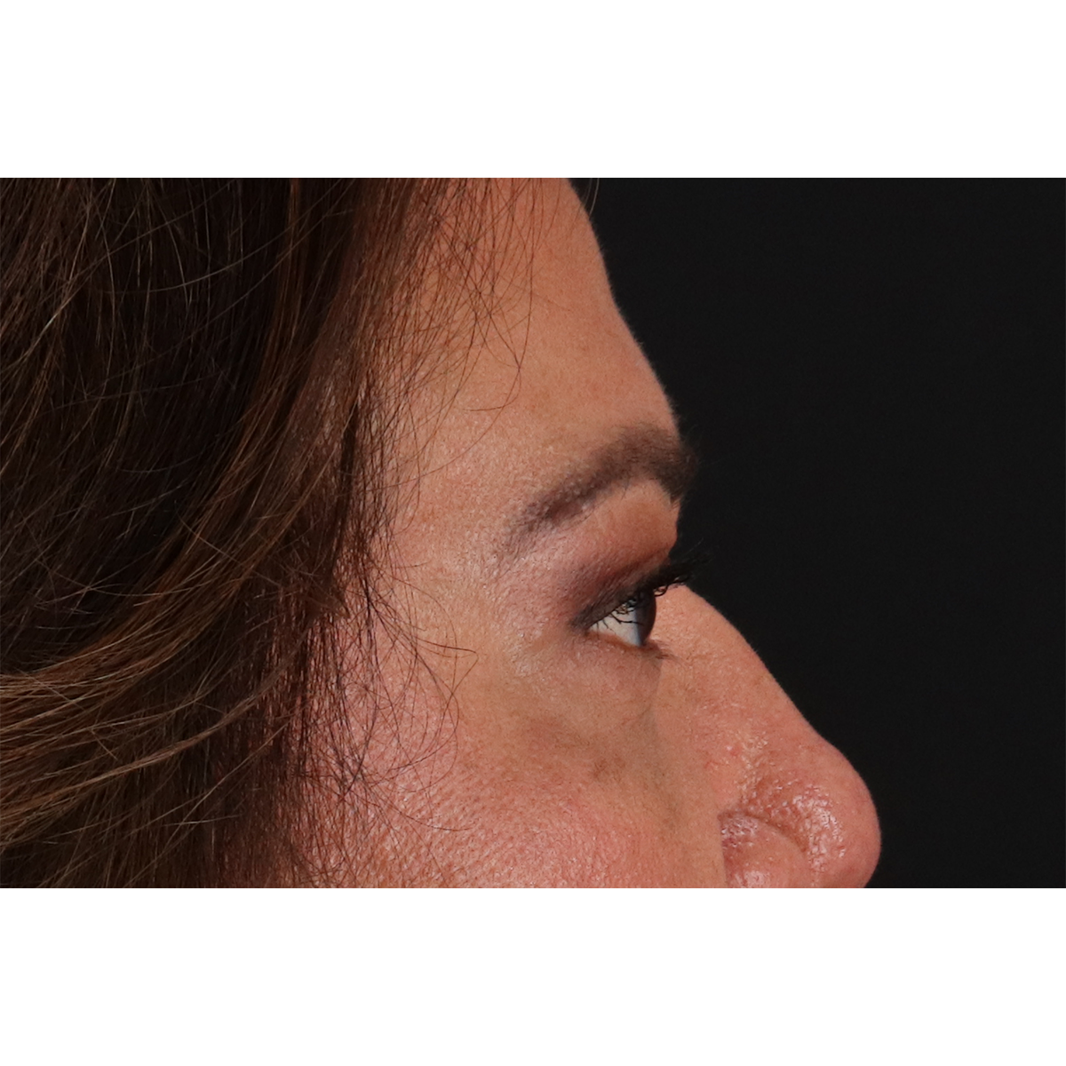 Blepharoplasty (Eyelid Surgery) Before & After Patient #11125