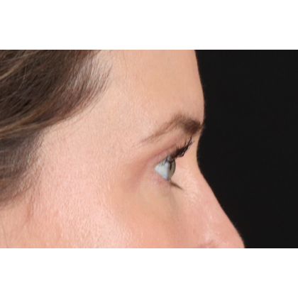 Blepharoplasty (Eyelid Surgery) Before & After Patient #11517