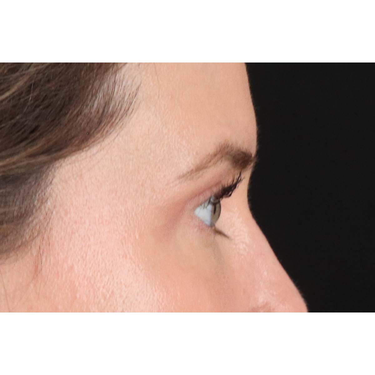 Blepharoplasty (Eyelid Surgery) Before & After Patient #11517