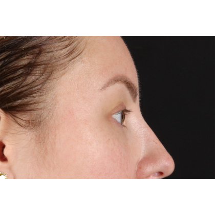 Brow Lift Before & After Patient #11657