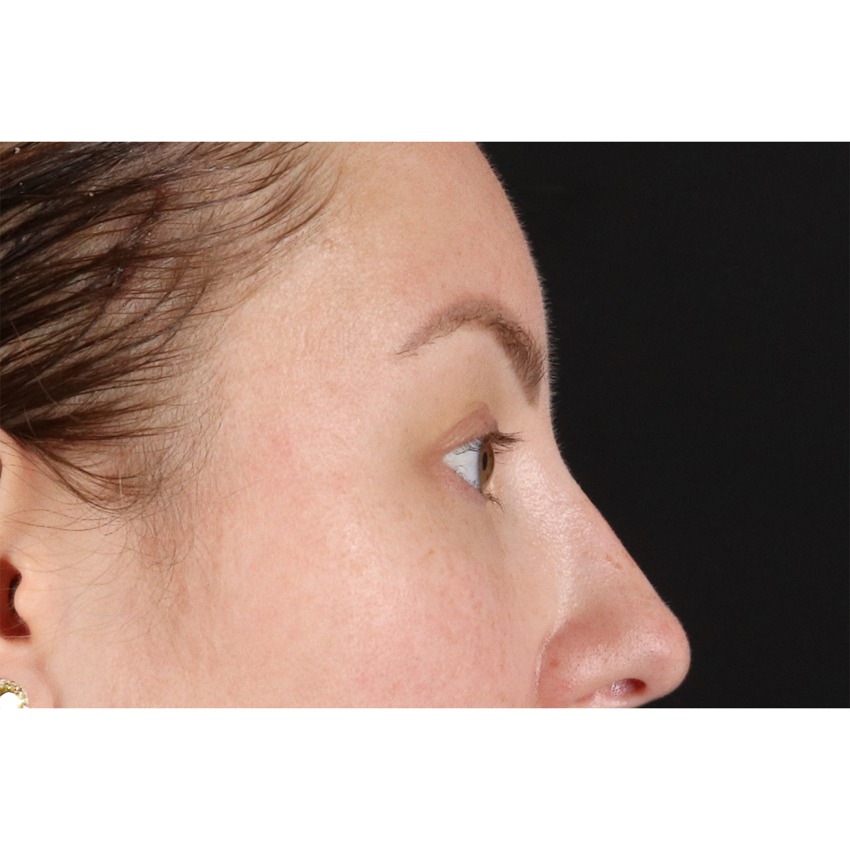 Brow Lift Before & After Patient #11657
