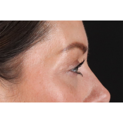 Blepharoplasty (Eyelid Surgery) Before & After Patient #11026