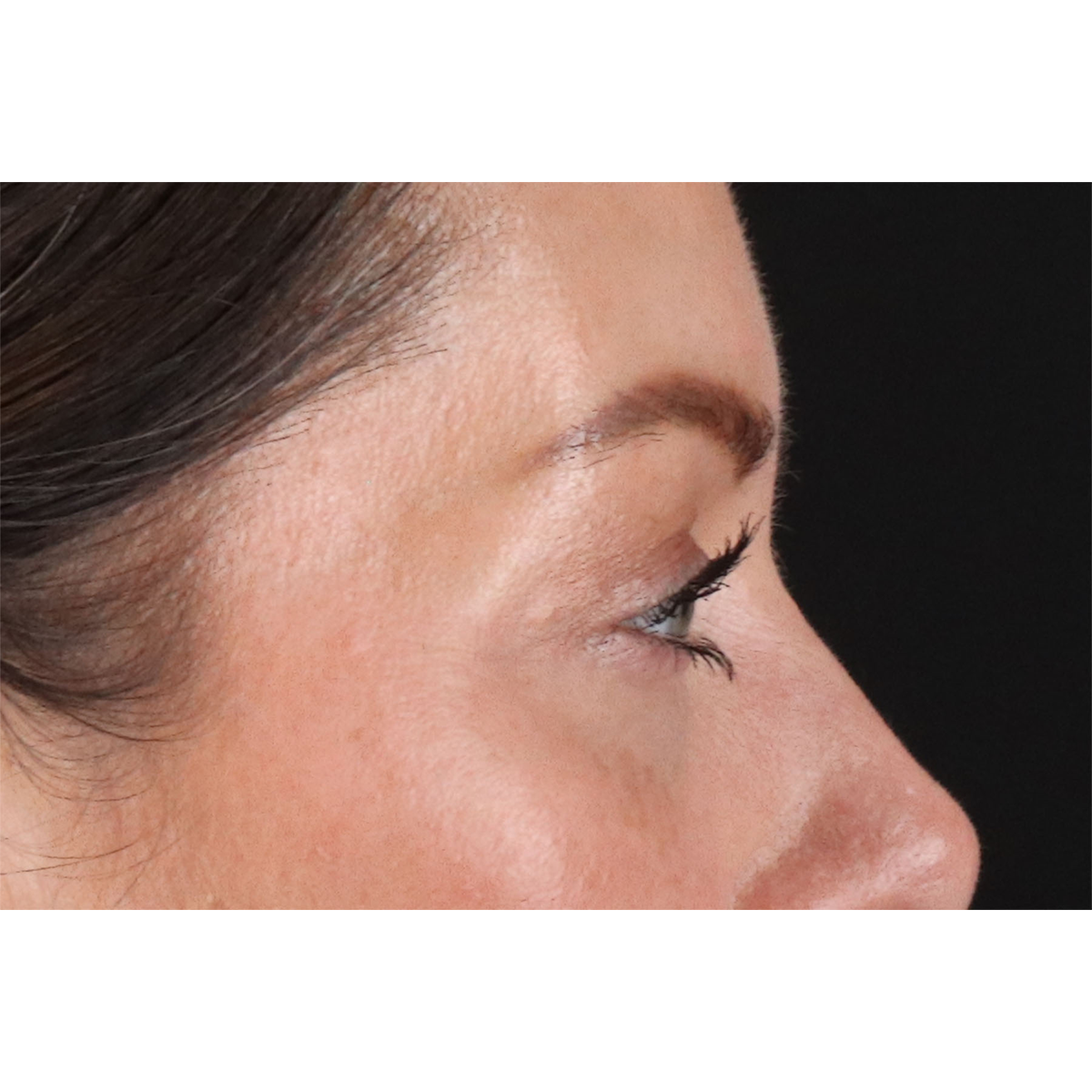 Blepharoplasty (Eyelid Surgery) Before & After Patient #11026