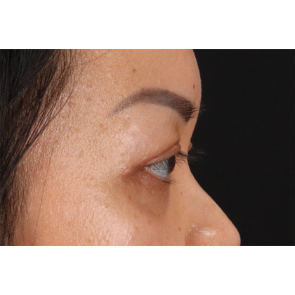Blepharoplasty (Eyelid Surgery) Before & After Patient #11037