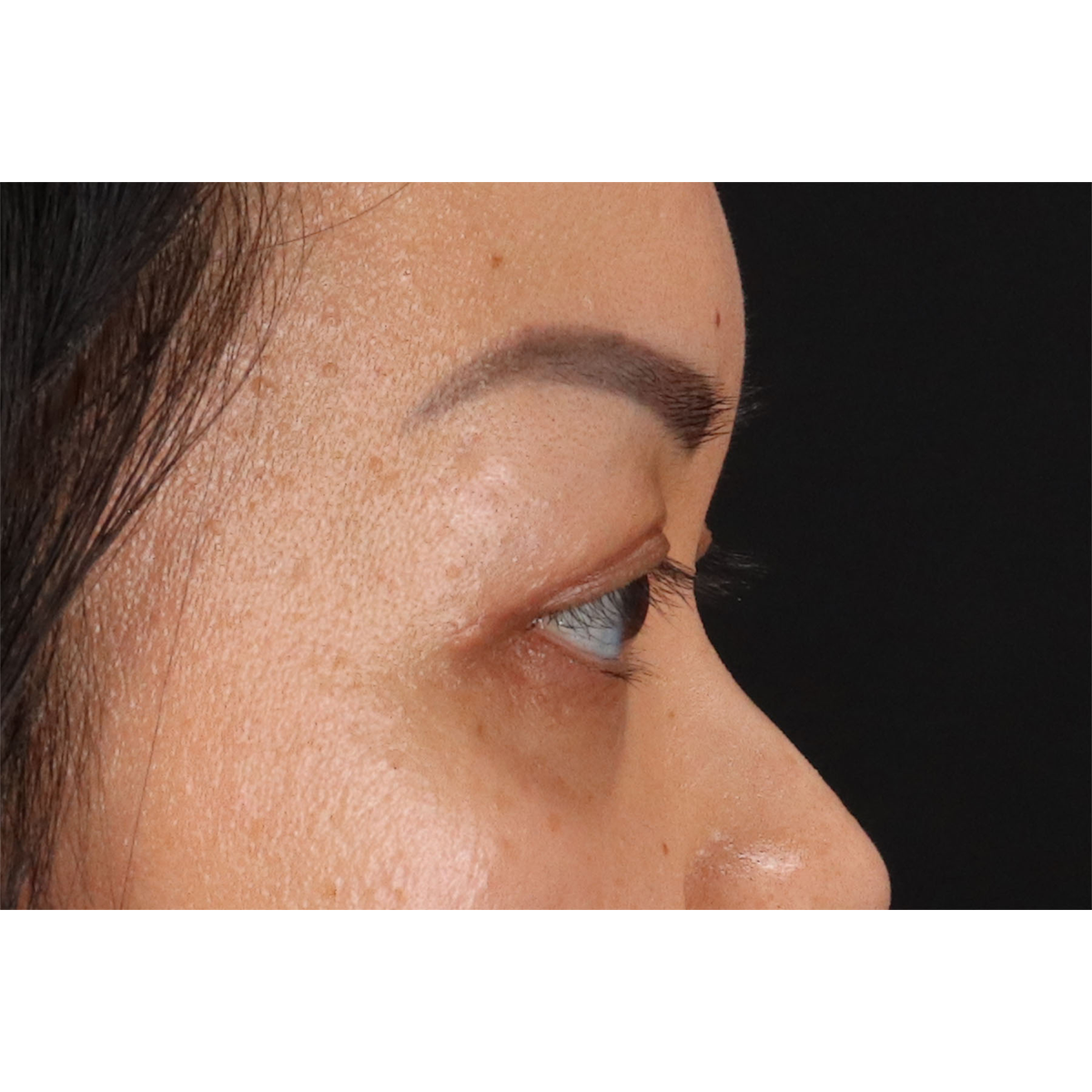 Blepharoplasty (Eyelid Surgery) Before & After Patient #11037
