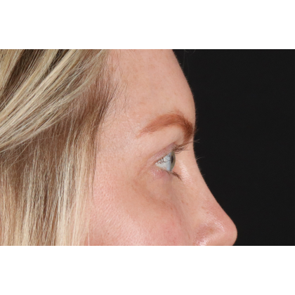 Blepharoplasty (Eyelid Surgery) Before & After Patient #11158