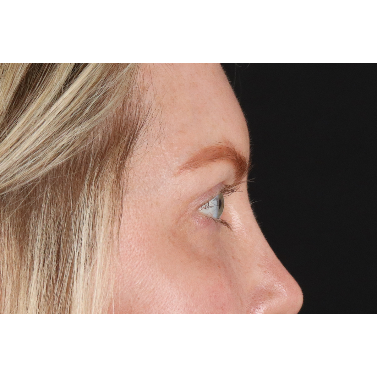 Blepharoplasty (Eyelid Surgery) Before & After Patient #11158