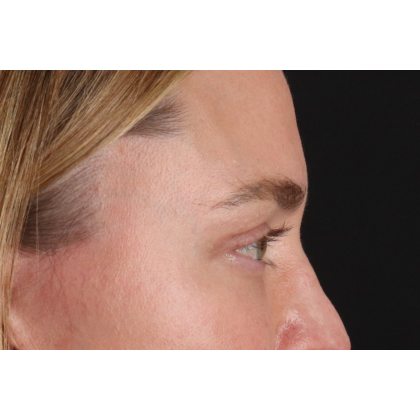 Blepharoplasty (Eyelid Surgery) Before & After Patient #11541