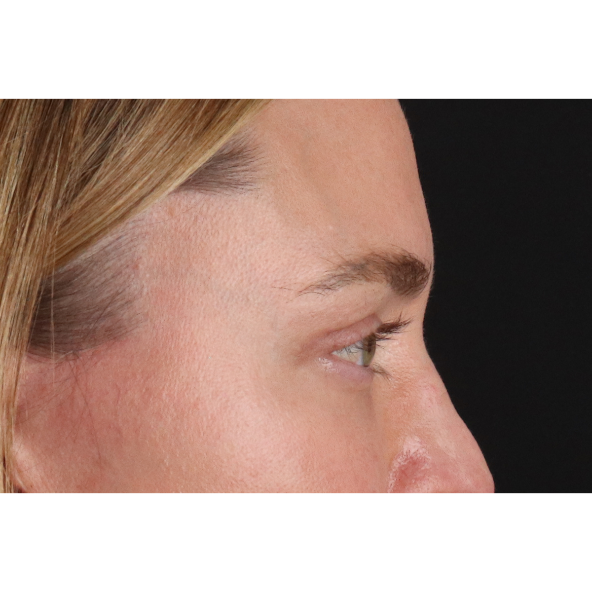 Blepharoplasty (Eyelid Surgery) Before & After Patient #11541