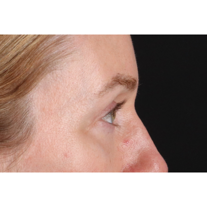 Blepharoplasty (Eyelid Surgery) Before & After Patient #11883