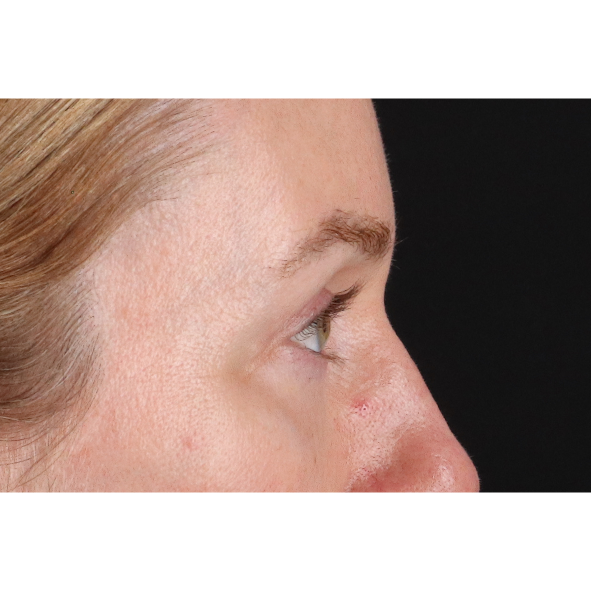 Blepharoplasty (Eyelid Surgery) Before & After Patient #11883