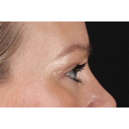 Blepharoplasty (Eyelid Surgery) Before & After Patient #11048