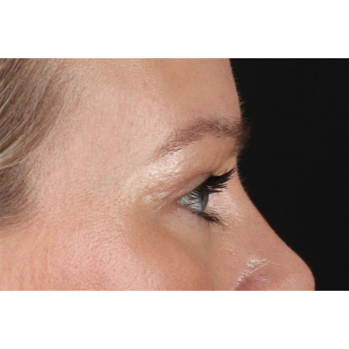Blepharoplasty (Eyelid Surgery) Before & After Patient #11048