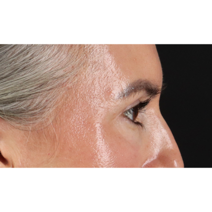 Blepharoplasty (Eyelid Surgery) Before & After Patient #11282