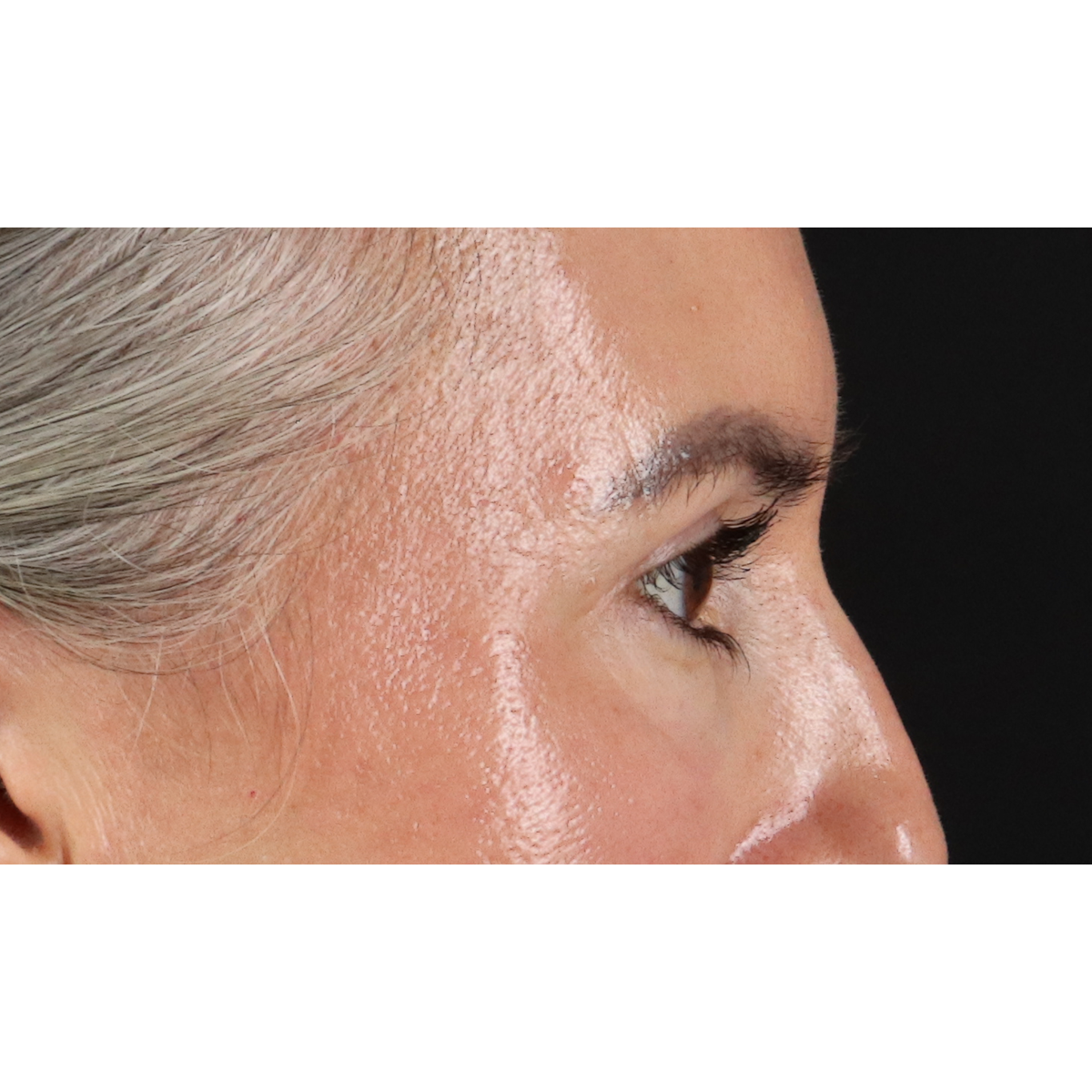 Blepharoplasty (Eyelid Surgery) Before & After Patient #11282