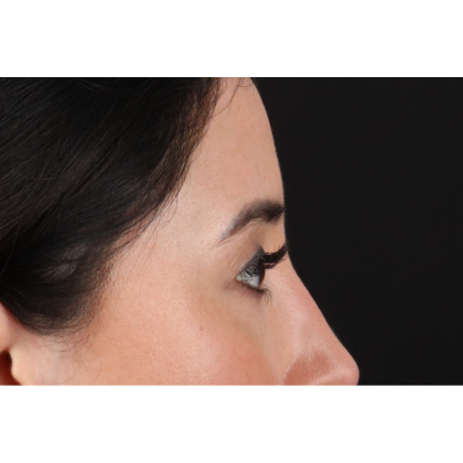 Blepharoplasty (Eyelid Surgery) Before & After Patient #11668