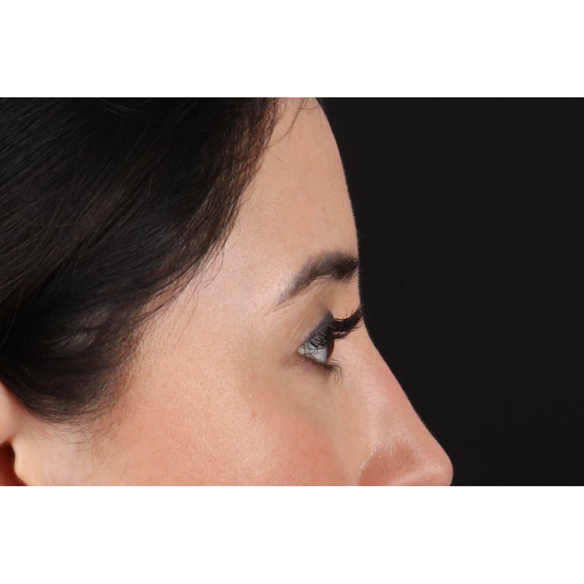 Blepharoplasty (Eyelid Surgery) Before & After Patient #11668