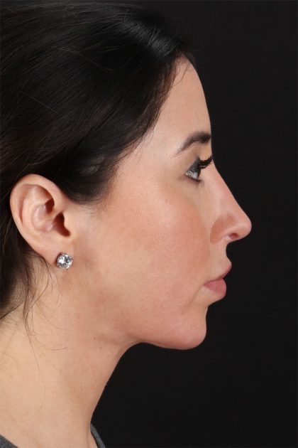 Fat Grafting To The Face Before & After Patient #11783