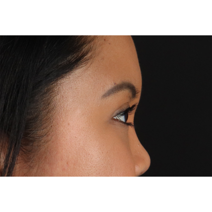 Brow Lift Before & After Patient #11646