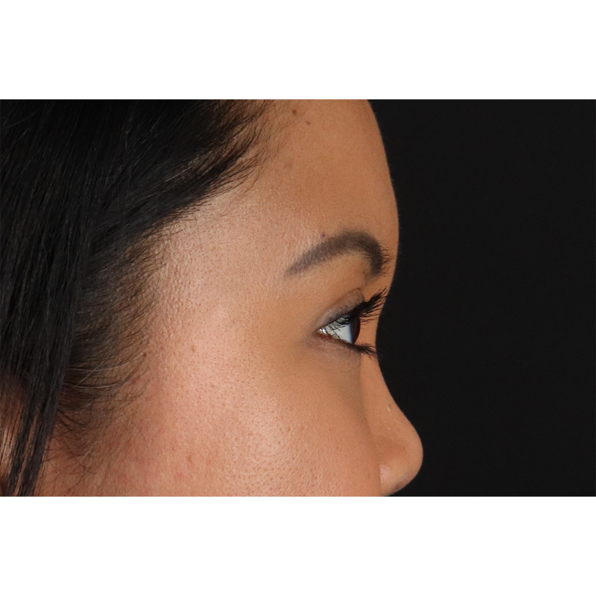 Brow Lift Before & After Patient #11646
