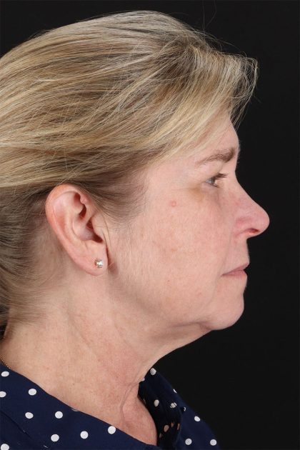 CO2 Laser Before & After Patient #11191