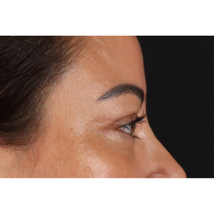 Blepharoplasty (Eyelid Surgery) Before & After Patient #11348
