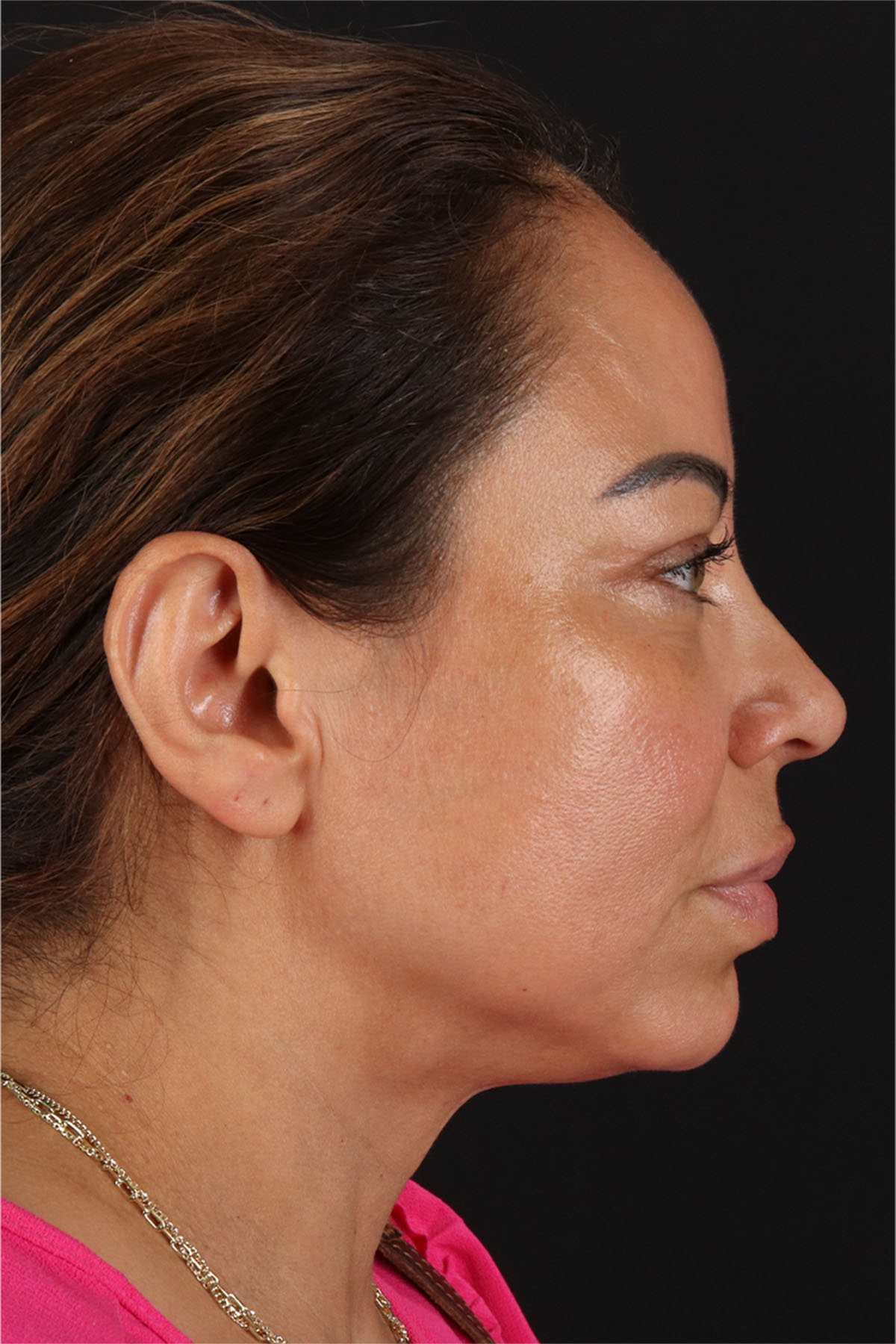 CO2 Laser Before & After Patient #11719
