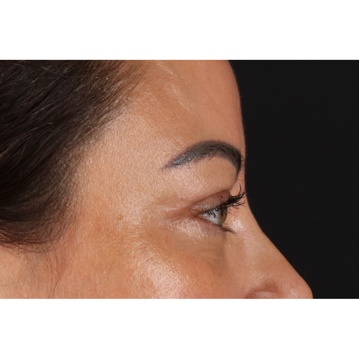 Blepharoplasty (Eyelid Surgery) Before & After Patient #11348
