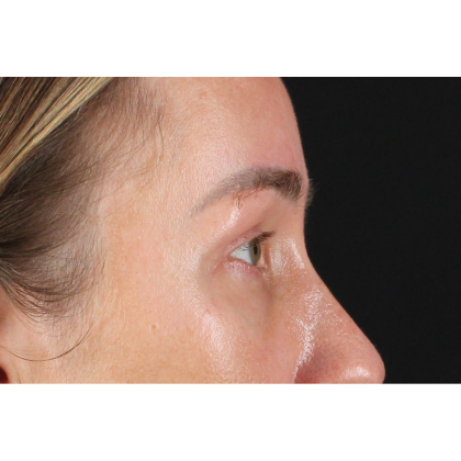 Blepharoplasty (Eyelid Surgery) Before & After Patient #11585