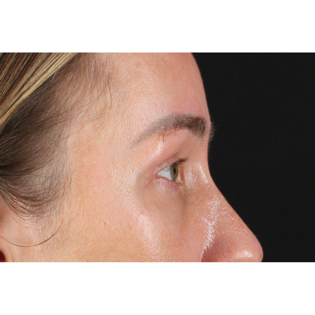 Blepharoplasty (Eyelid Surgery) Before & After Patient #11585