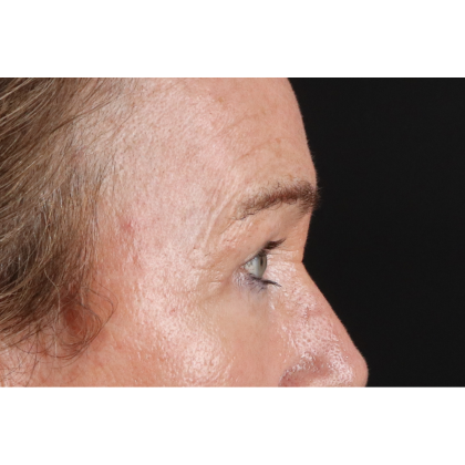 Blepharoplasty (Eyelid Surgery) Before & After Patient #11404