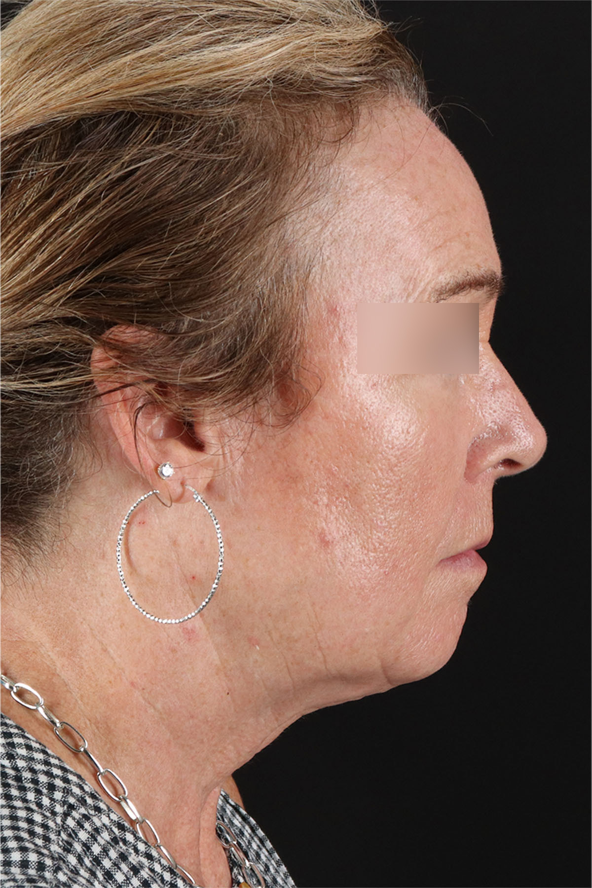 CO2 Laser Before & After Patient #11385