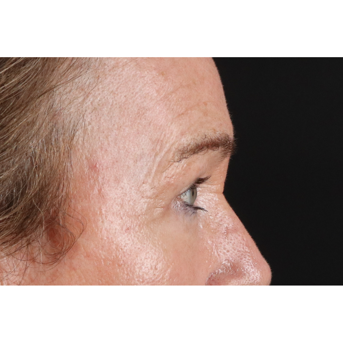 Blepharoplasty (Eyelid Surgery) Before & After Patient #11404