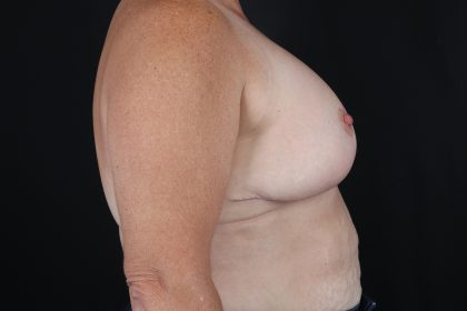 Breast Reduction With Lift Before & After Patient #10530