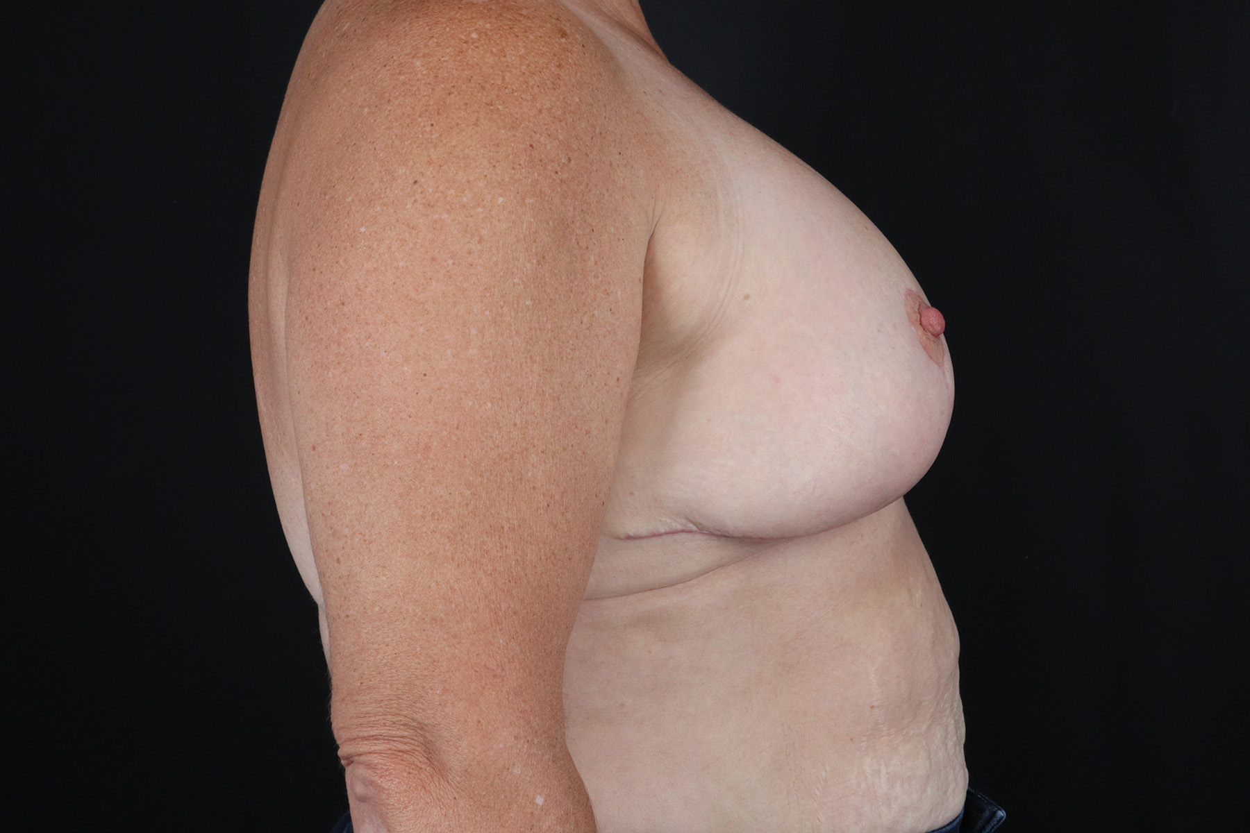 Breast Reduction With Lift Before & After Patient #10530