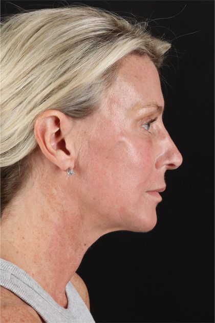 Facelift Before & After Patient #11682