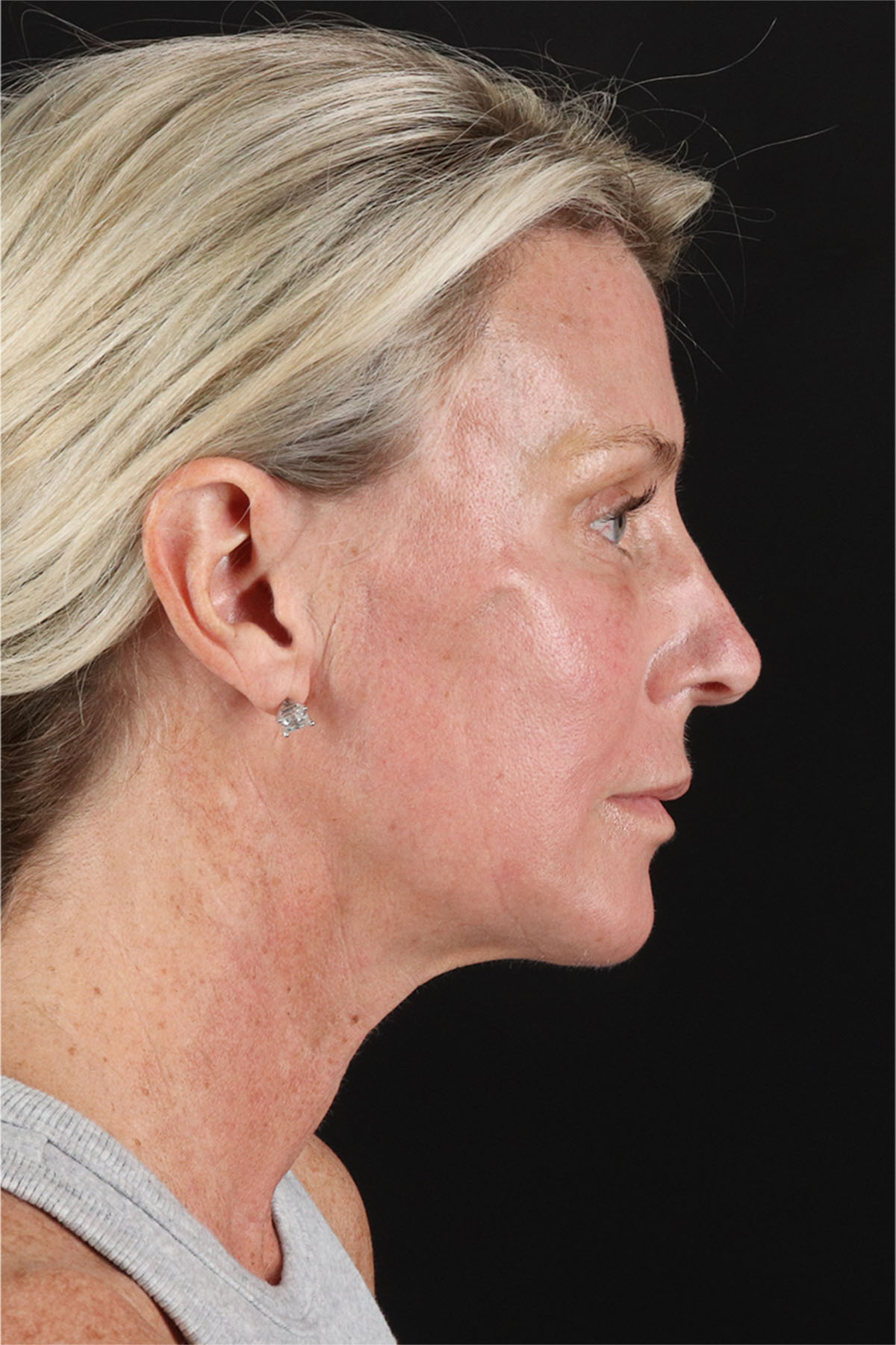 Facelift Before & After Patient #11682