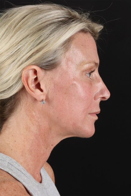 CO2 Laser Before & After Patient #11202