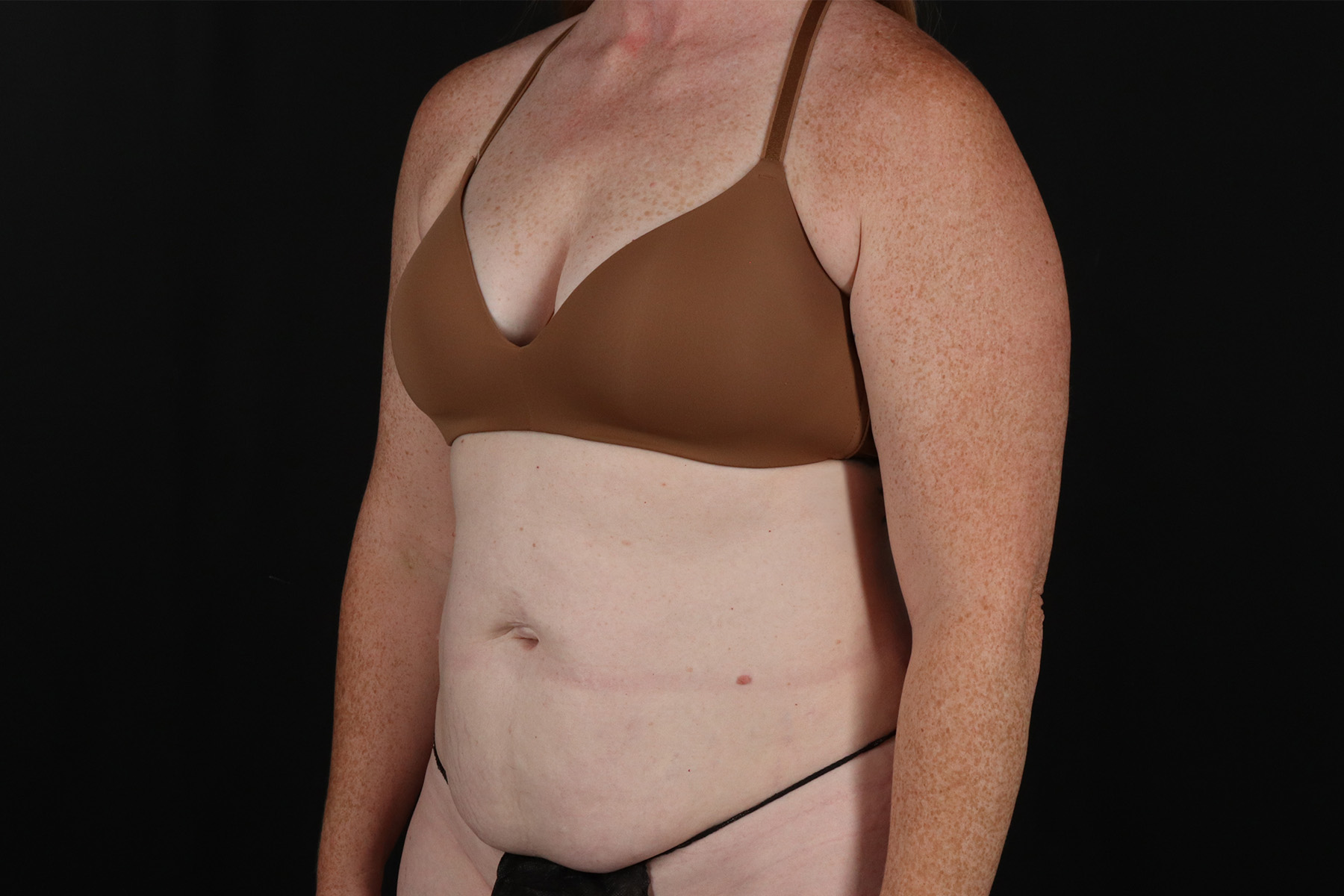 Abdominoplasty (Tummy Tuck) Before & After Patient #9980