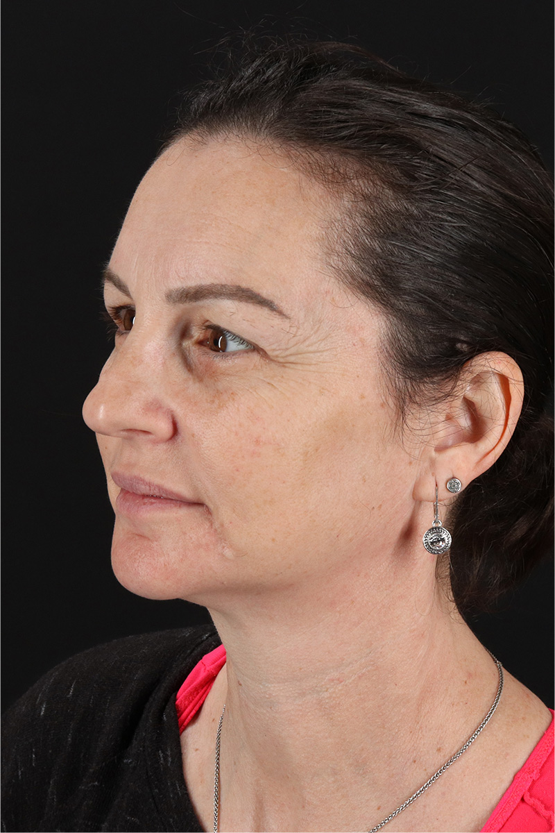 Chemical Peels Before & After Patient #11418
