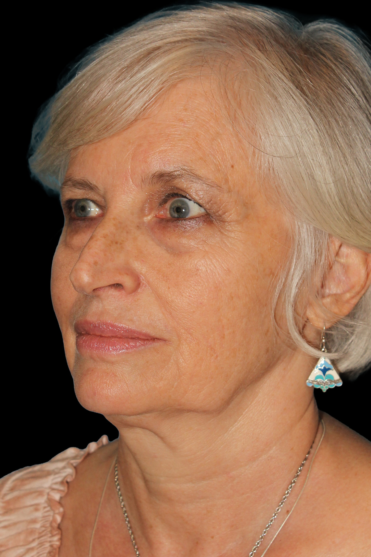 Lower Blepharoplasty Before & After Patient #12997