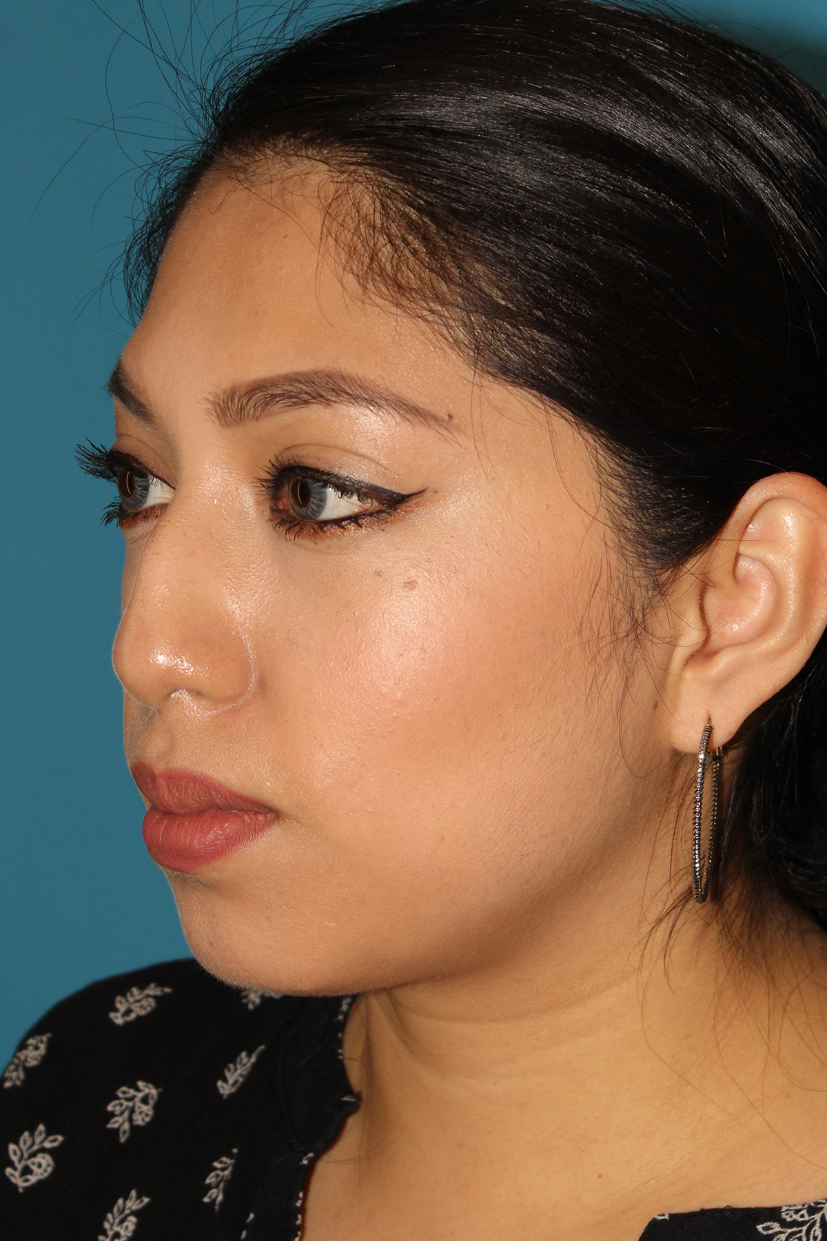 Chin Implant Before & After Patient #13673