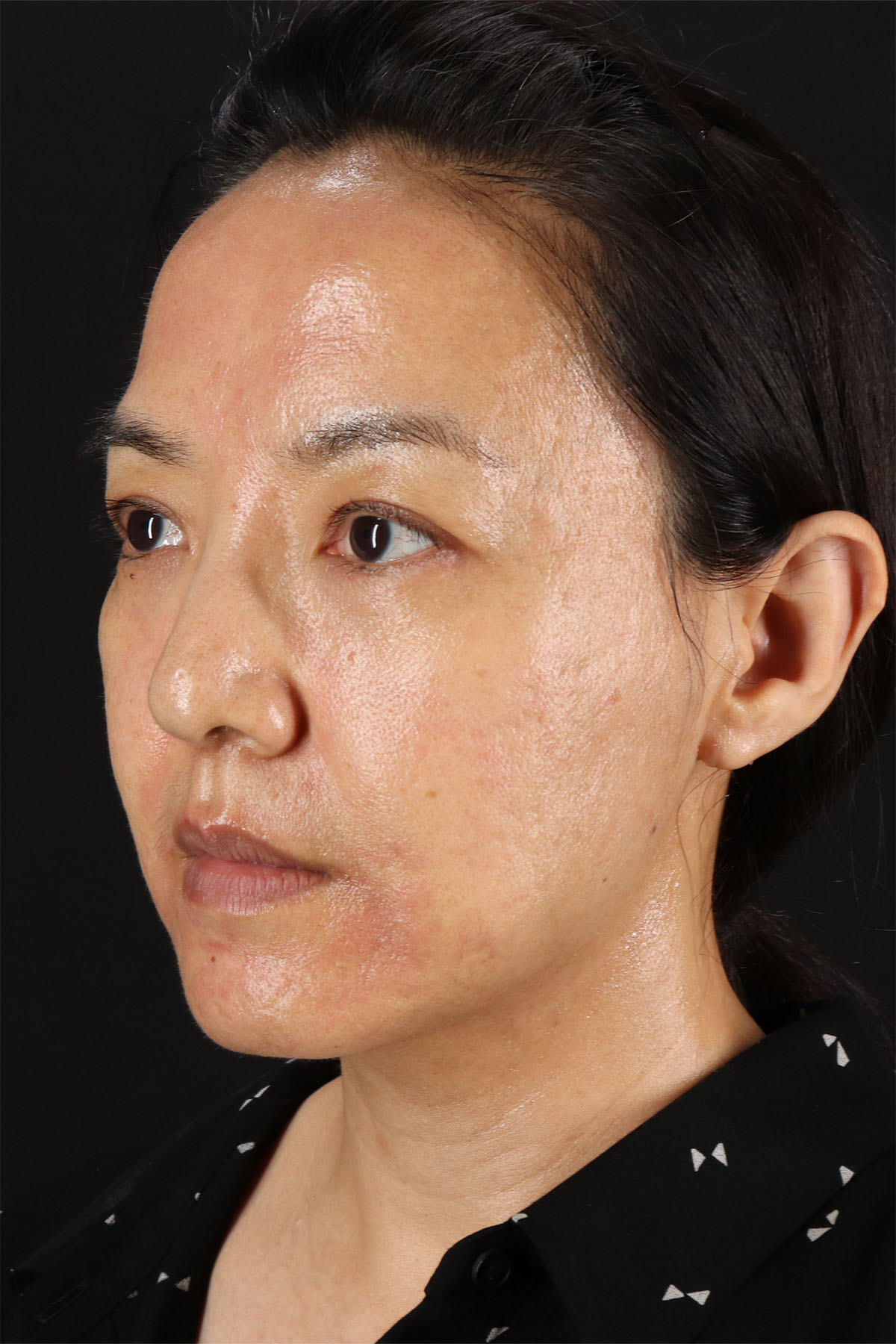 CO2 Laser Before & After Patient #11059