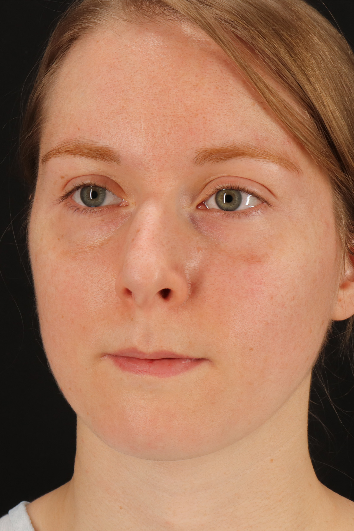 Rhinoplasty Before & After Patient #12238