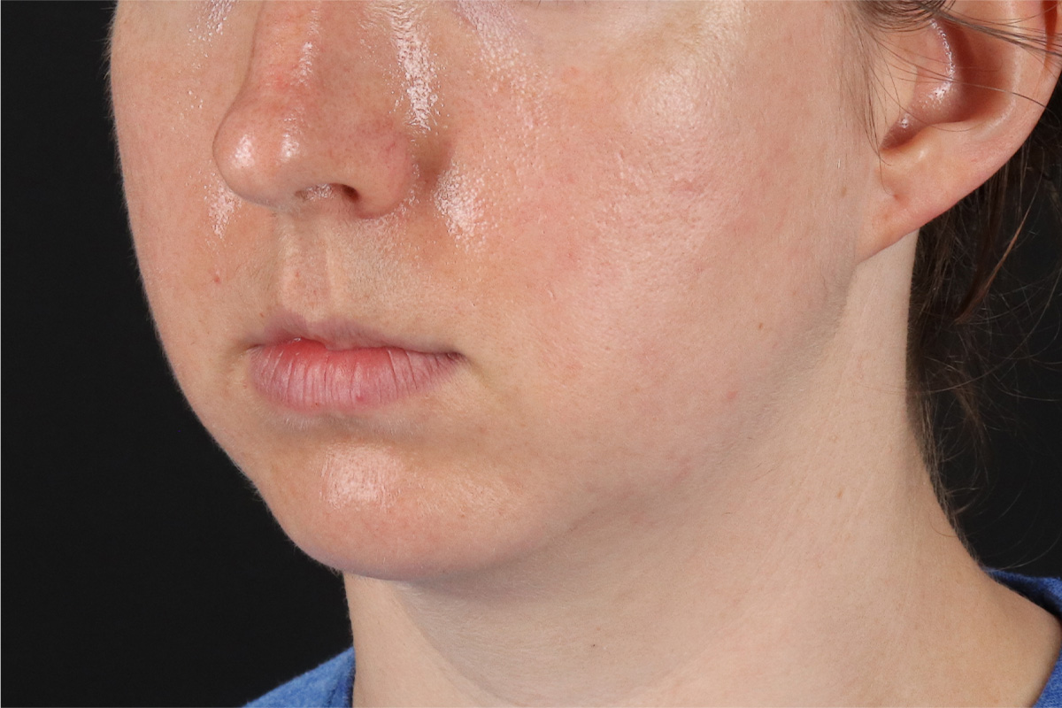 Chin Implant Before & After Patient #13761