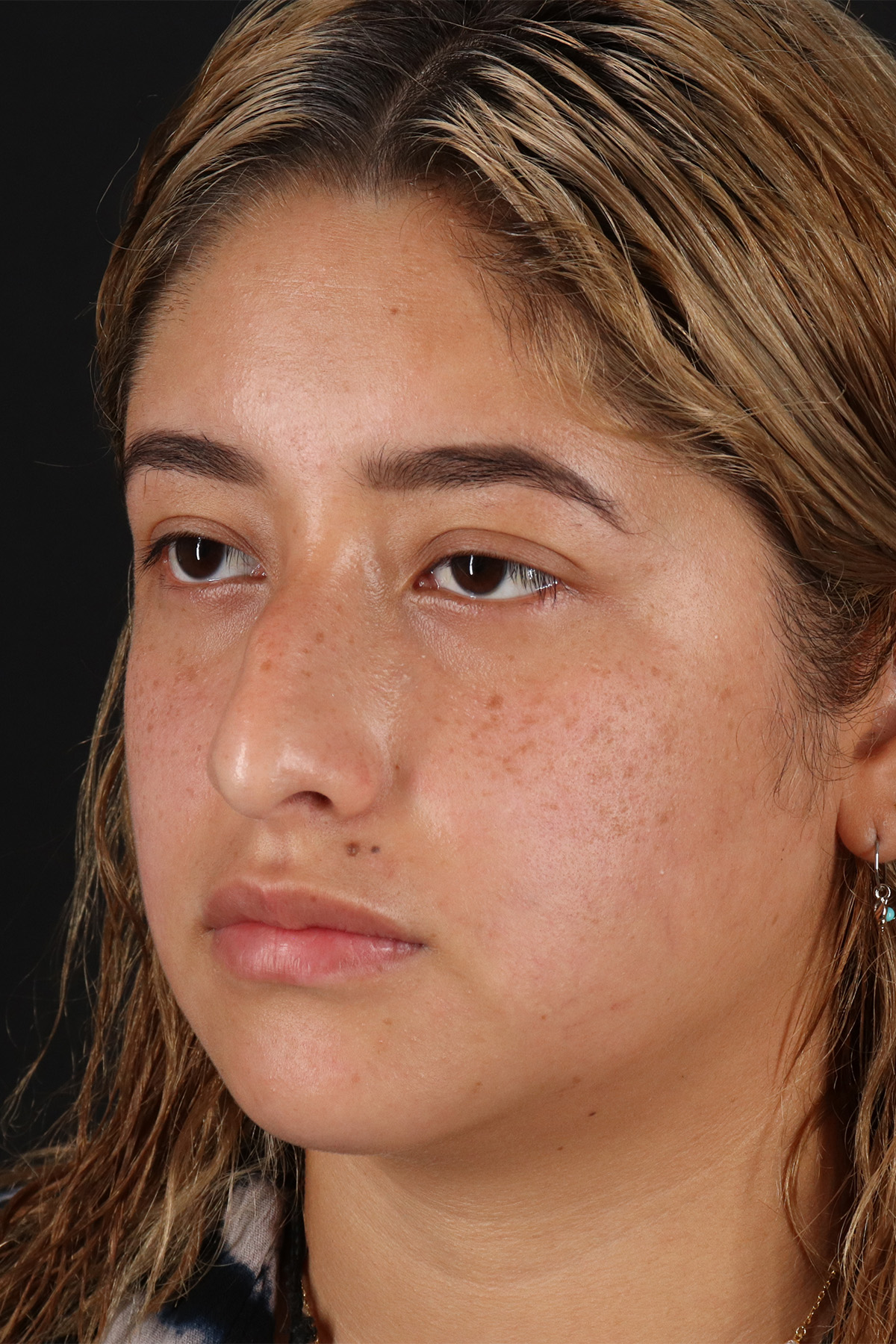 Rhinoplasty Before & After Patient #12491