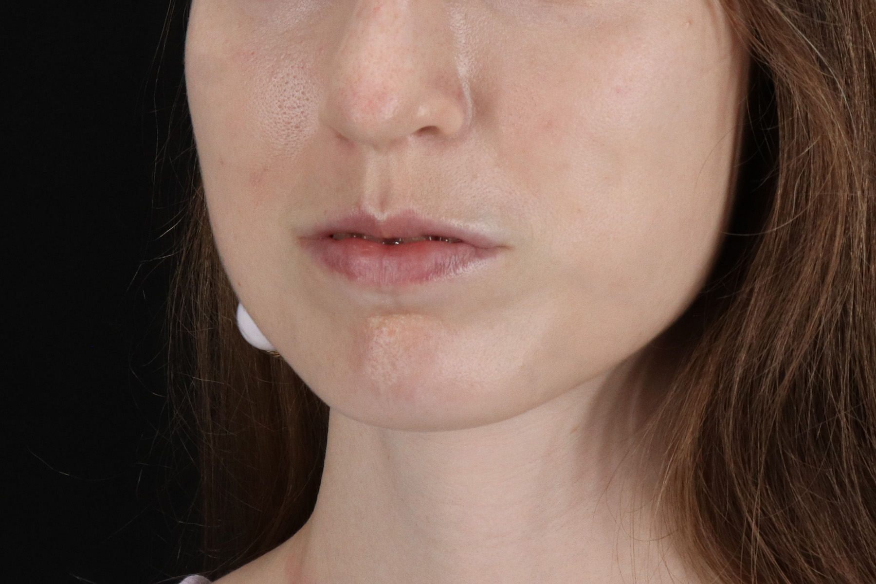 Buccal Fat Pad Before & After Patient #14025